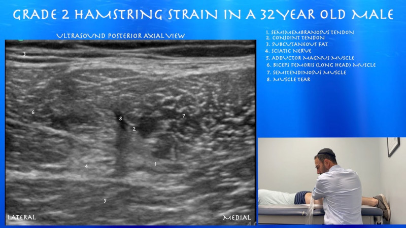 Luka Doncic’s Hamstring Injury: Navigating the Grade 2 Hamstring Strain