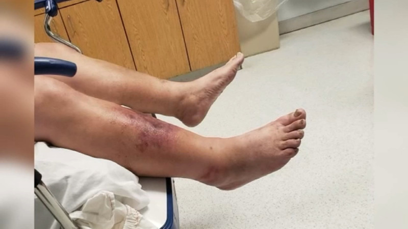 Louisiana’s Flesh-Eating Bacteria Crisis: A Worsening Epidemic